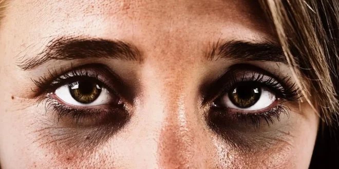 Cara Menghilangkan Mata Panda Secara Alami